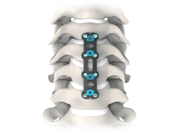 Trimi Anterior Cervical Plate System