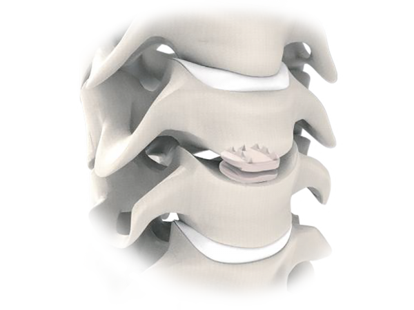 D-Motion Peek Cervical Disc Prosthesis